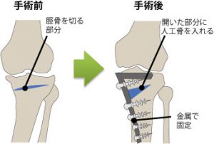 手術をする前に,ちょっと考えてください！（膝のいたみ③）