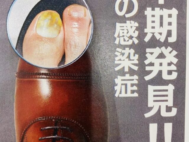 「爪の水虫（爪白癬）」を治療しよう！
