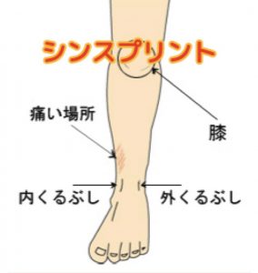 スポーツ中のスネの痛み、シンスプリントについて！