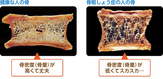 骨粗しょう症研究会に行ってきました！