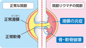 関節リウマチについて